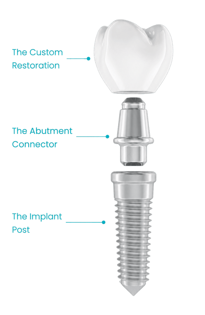 Implant diagram